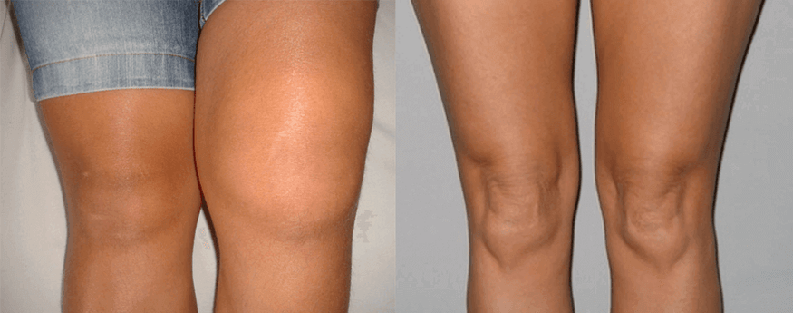 Doświadczenie w stosowaniu kapsułek Cannabis Oil przed i po użyciu od Eva